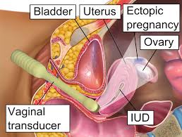 This is ectopic pregnancy