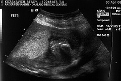 20 weeks ultrasound result 
